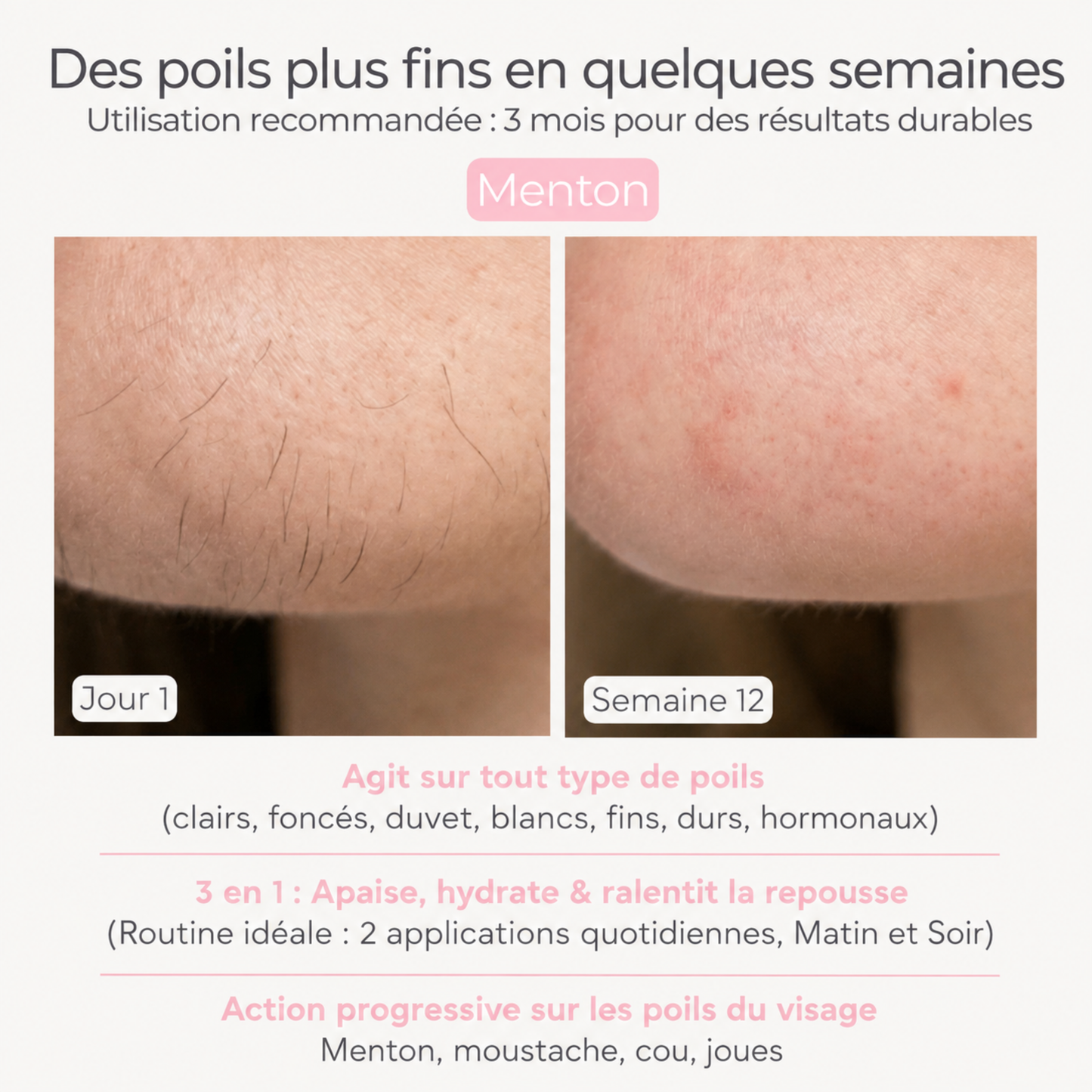 Huile pour réduire les poils – Formule 100 % naturelle