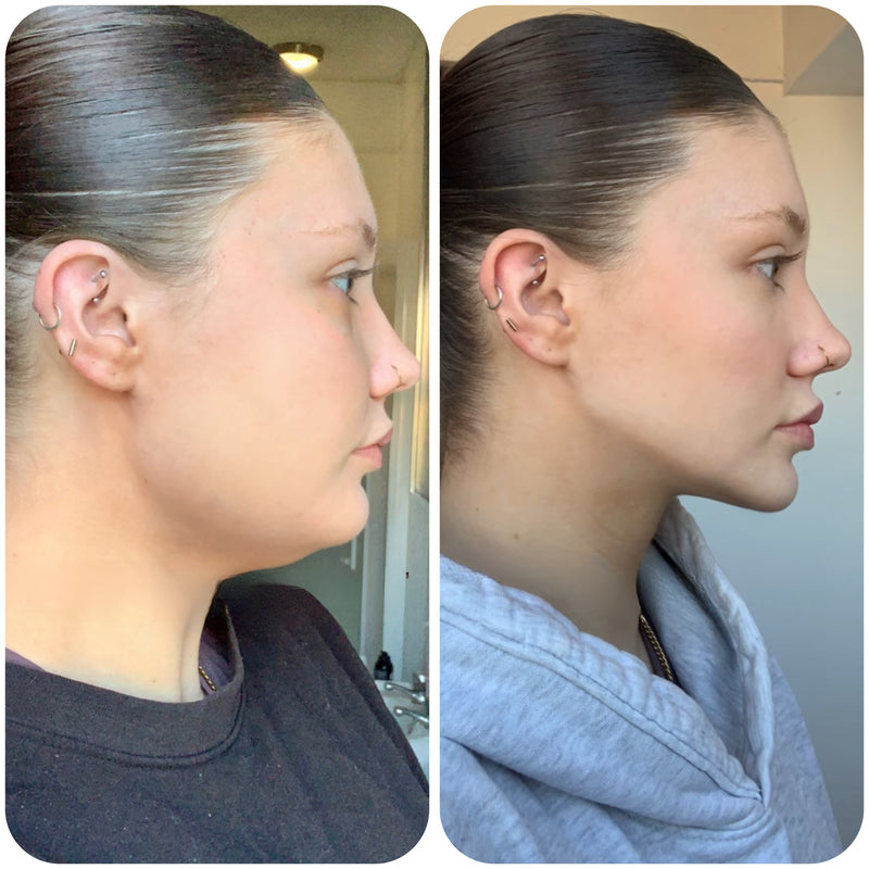Avant après d'Ambre après utilisation de la gaine SweetLifty montrant un visage plus affiné et un ovale du visage mieux défini.