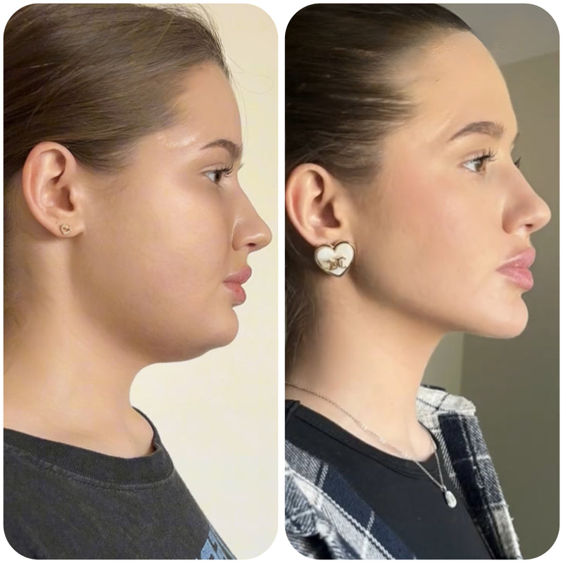 Résultat avant après d'Anaïs avec la gaine SweetLifty pour affiner l'ovale du visage et réduire l'apparence du double menton.