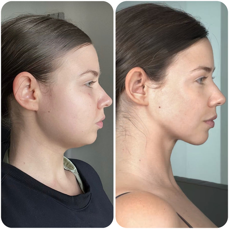 Avant après de Romane après utilisation de la gaine SweetLifty montrant un visage plus affiné et un ovale du visage mieux défini.
