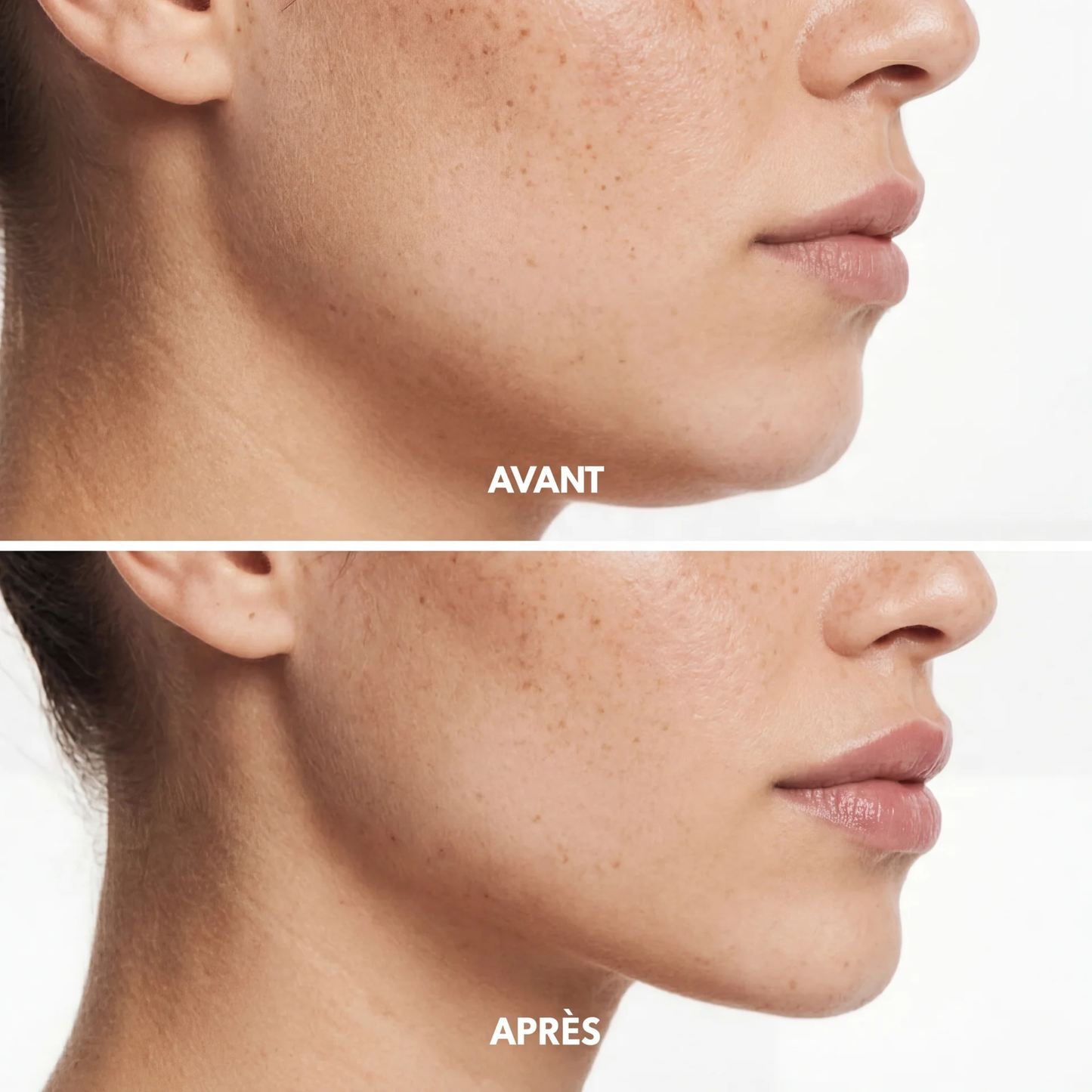 Avant après montrant les résultats de la gaine SweetLifty avec un ovale du visage plus défini et une apparence réduite du double menton.