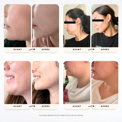 Montage de plusieurs photos avant après de clientes utilisant la gaine SweetLifty avec un ovale du visage plus défini et une apparence réduite du double menton.