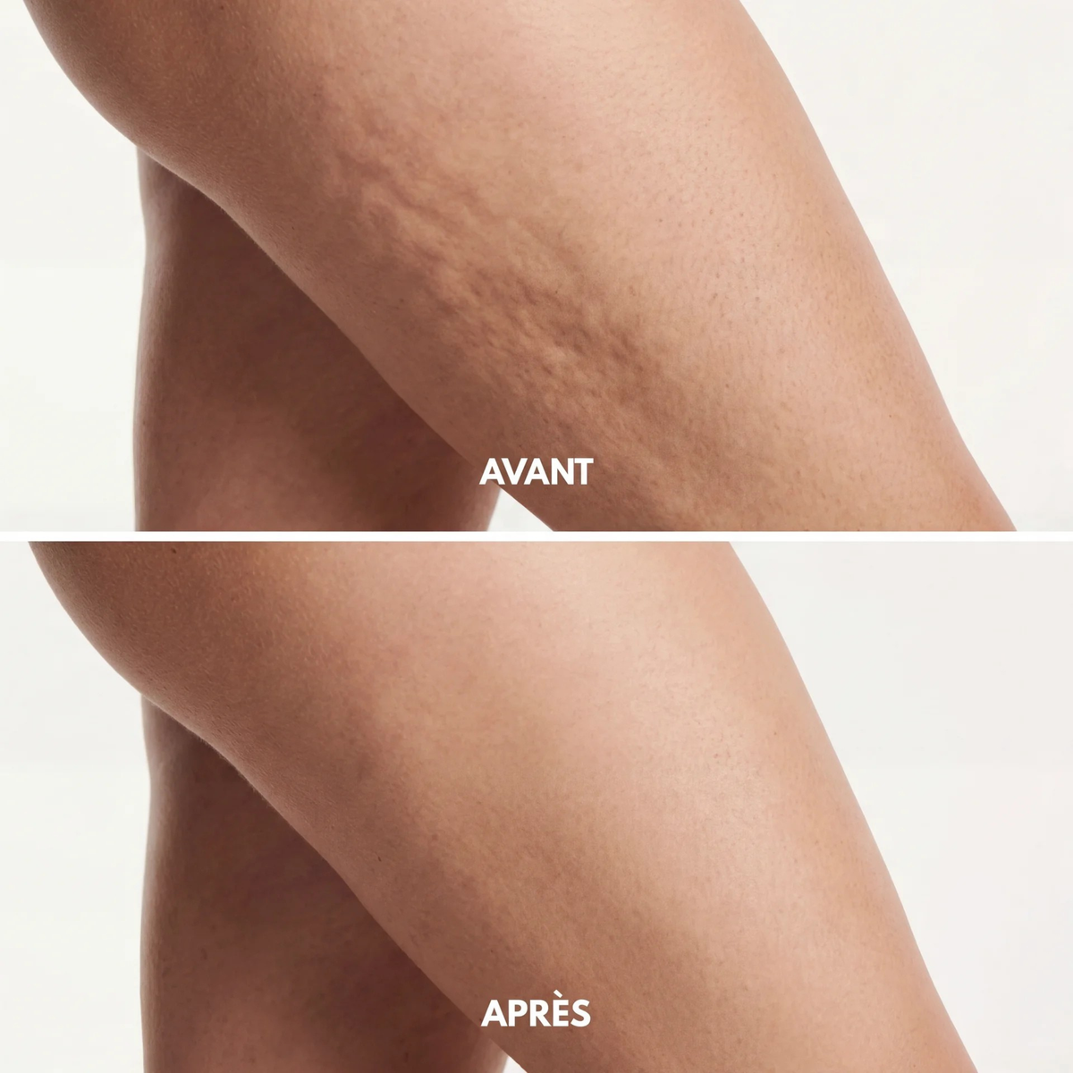 Avant après sur la cellulite des cuisses avec le masseur anti-cellulite SweetLifty
