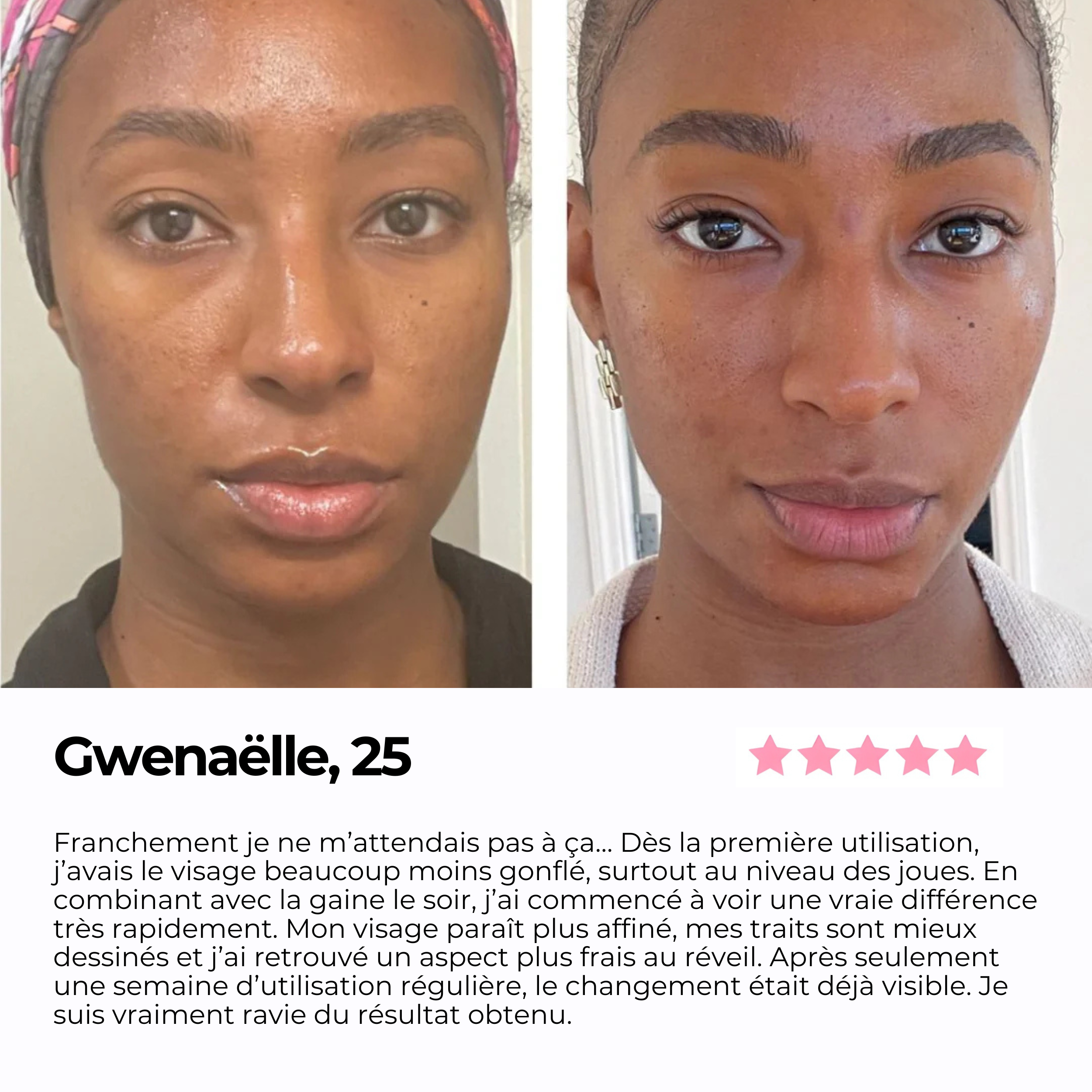 Avant/après d'une cliente de 25 ans après une semaine d'utilisation régulière de la brosse lymphatique et de la gaine visage SweetLifty. Le témoignage évoque un visage moins gonflé, des traits plus affinés et un effet bonne mine dès les premières utilisations.